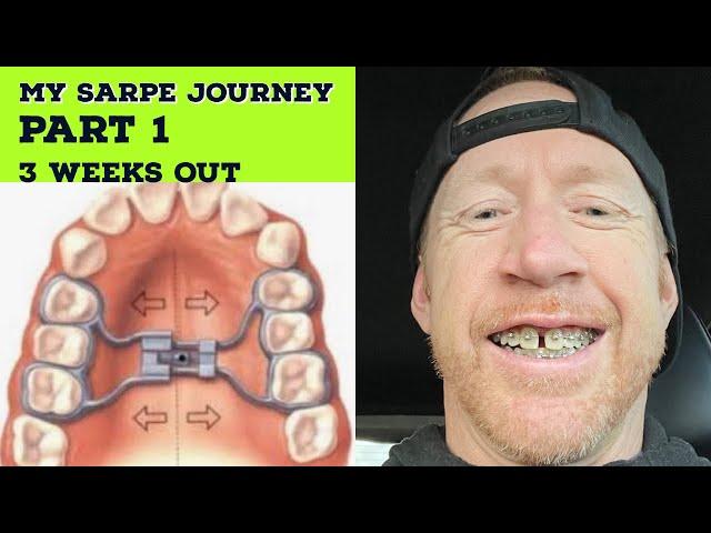 MY SARPE JOURNEY: PART 1 (3 WEEKS OUT) MY QUEST TO FIND A CURE FOR CHRONIC FATIGUE SYNDROME CFS/ME