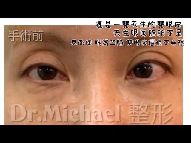 眼窩凹陷雙眼皮手術-案例分享-沈筠惇醫師