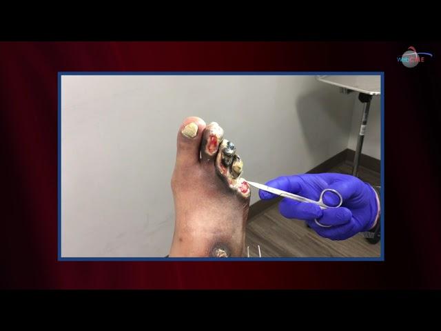 WCW: Amputating Necrotic Toes after Frostbite Injury