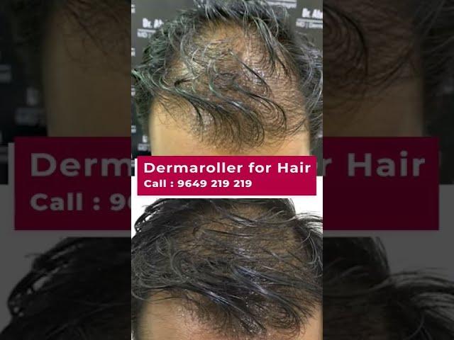 Derma Roller For Hair Treatment Has The Answer To Everything | viral #shorts  #dermaroller