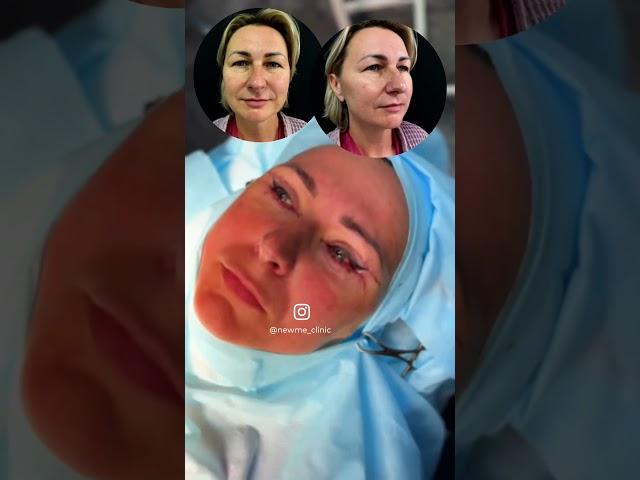 Как проходит операция пластики век #блефаропластика