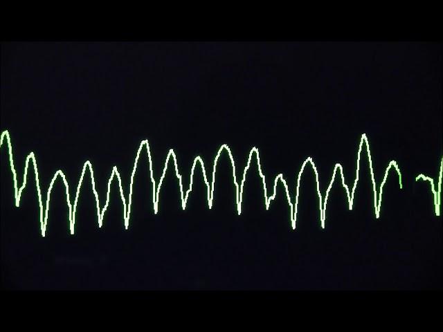 Cardiac arrest rhythms, VF, VT, Asystole and PEA