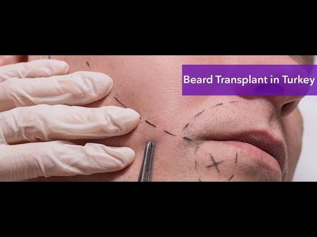 Beard Transplant Turkey |  Beard Transplant Cost Turkey