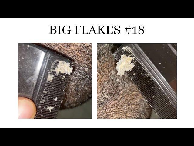 Dandruff combing#18 BIG FLAKES