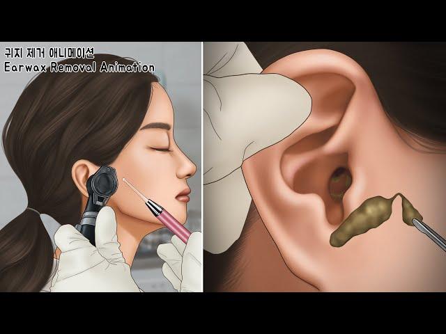 ASMR 시원함 주의! 엄청난 초거대 왕건이가 쏙~ 귀지 제거 | 귀청소 | Oddly Satisfying Massive Earwax Removal | Ear cleaning
