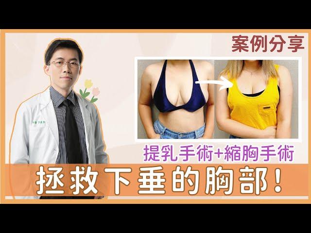 【提乳+縮胸手術｜真實見證】二寶媽的苦誰人知  讓產後下垂的ㄋㄟㄋㄟ找回正確位置｜整形外科 陳廣得醫師