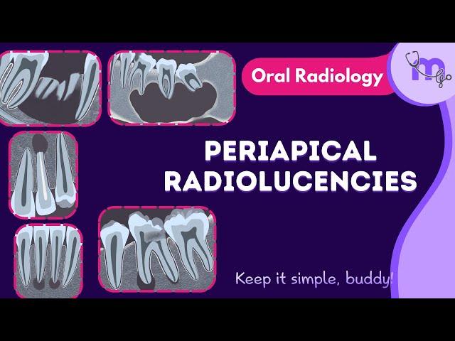 Periapical radiolucencies - Differential diagnosis , Radiographic features | Oral Radiology