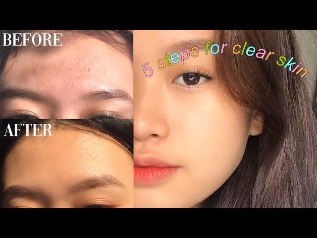 MY 5 BASIC STEPS FOR CLEAR SKIN  (Philippines)