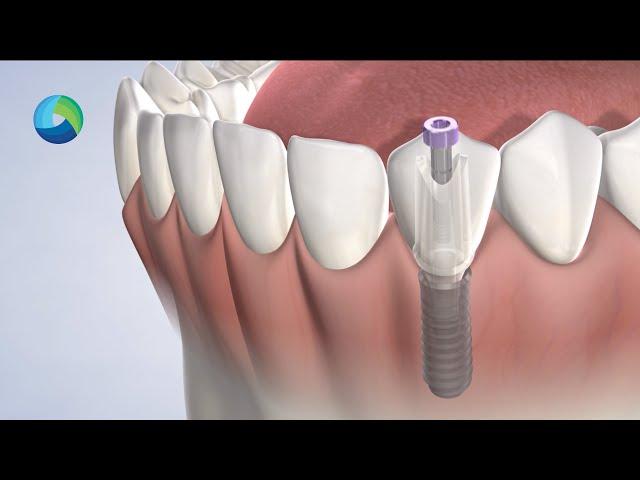 Dental Implant Quality in New Brunswick NJ: Dr. Richard Stern | Oral Surgery Group