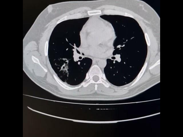 Atoll sign /Reversed halo sign of Angio invasive pulmonary aspergillosis.