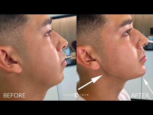 MALE FACIAL SCULPTING: DEFINING THE JAWLINE AND CHIN WITH RADIESSE FILLER | DR JASON EMER