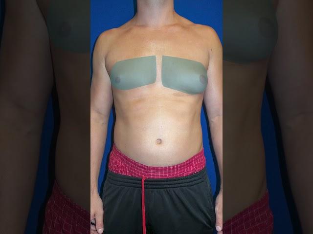 Gynecomastia and Armpit Fat Removed by Board Certified Plastic Surgeon