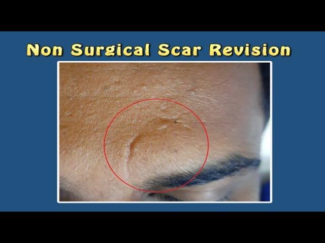 Non Surgical Scar Revision with Cannula & Laser. For Enquiry Contact: 970002 0802