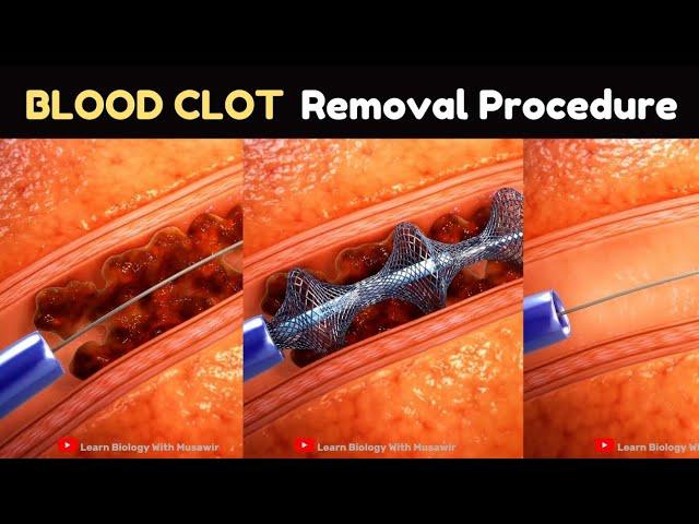 Blood Clot Removal Procedure | Medical Animation