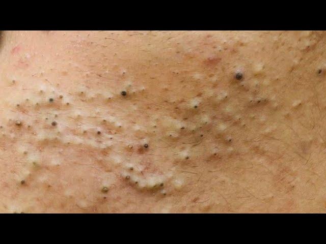 Say Goodbye to Blackheads: Top Removal Techniques Revealed!