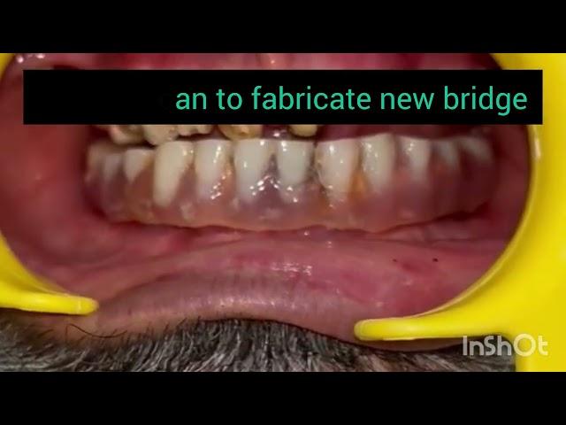 कैसे लगाए जाते हैं नए दांत, पूरी प्रक्रिया देखें इस वीडियो में #bridgemaking #new teeth