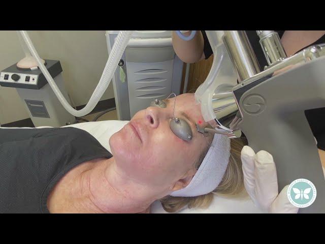 Monarch Skin Rejuvenation Profractional - Live