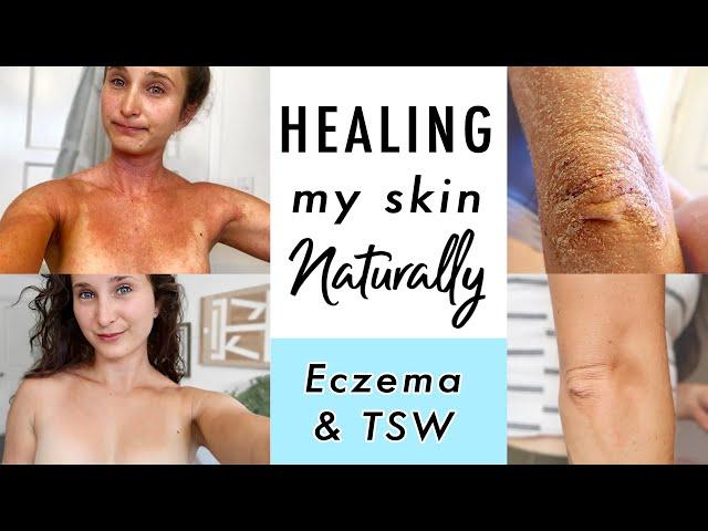 How I CURED Eczema & Topical Steroid Withdrawal NATURALLY | My Skin Healing Journey