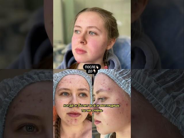 История лечения АКНЕ