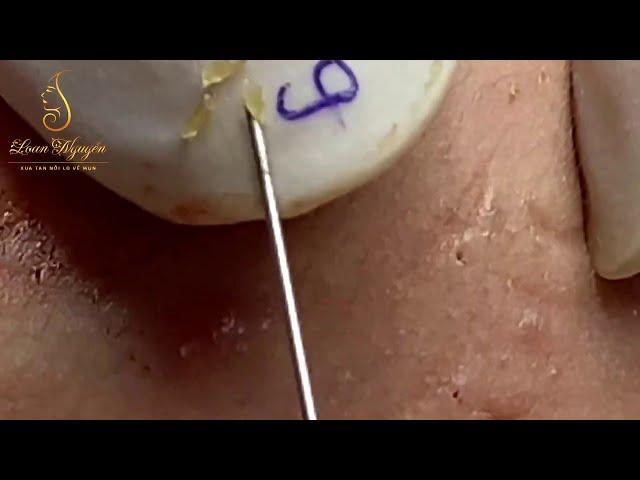 Blackheads extraction  (279_ep 1) | Loan Nguyen