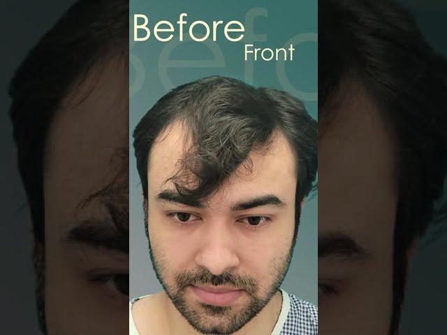 Hair Transplant Results Frontal + Crown #shorts