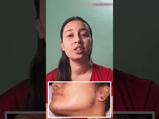 चेहरे पर बाल / Facial hair in PCOS. #shorts #youtubeshorts