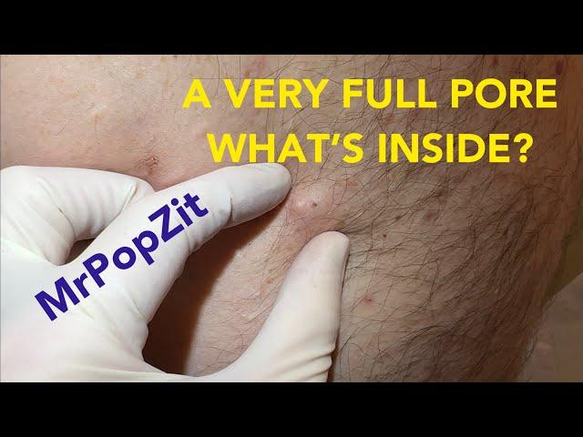 Very full pore! Let’s see what’s inside. Do you think it’s just a clogged pore or is there a sac?