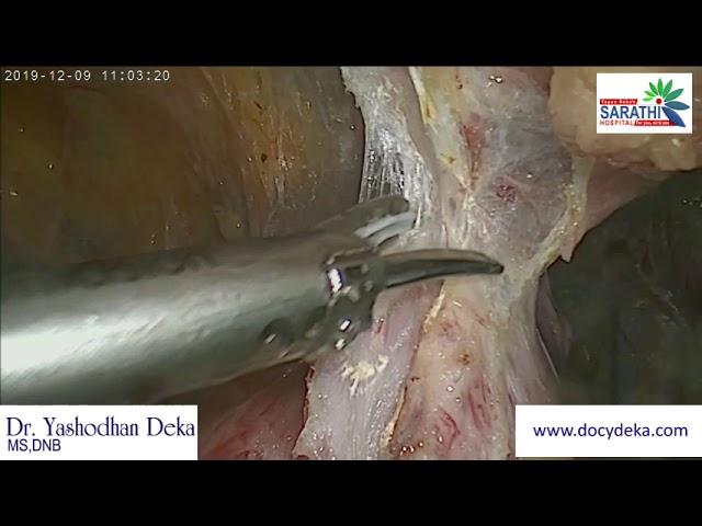 THRICE POST CS  for TOTAL LAPAROSCOPIC HYSTRECTOMY