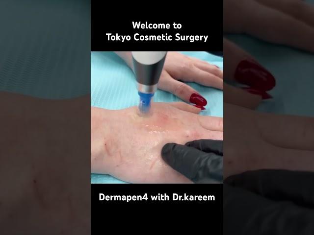 Dermapen4 with Dr.kareem at Tokyo cosmetic surgery in Dubai