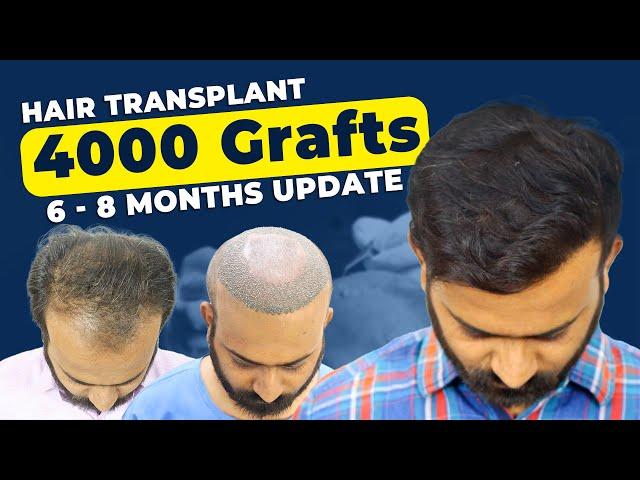 Best Hair Transplant Clinic In Bhopal|| Hair Transplant Patient Review || Cost of Hair Transplant