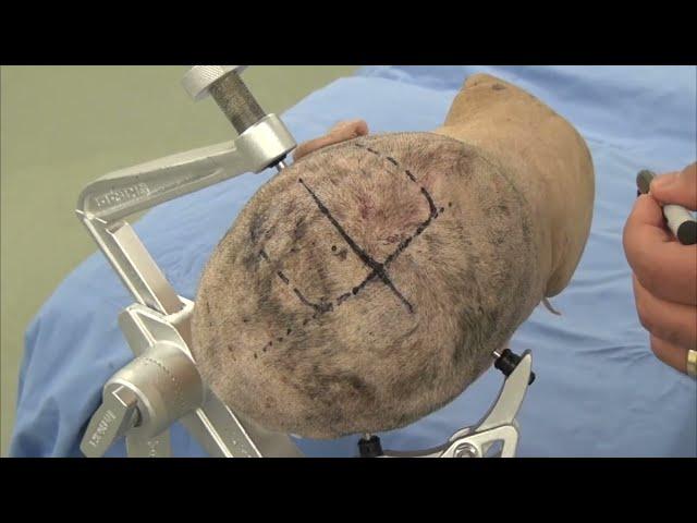 Skull Clamp Placement: Parietal Craniotomy-Incision (Preview)