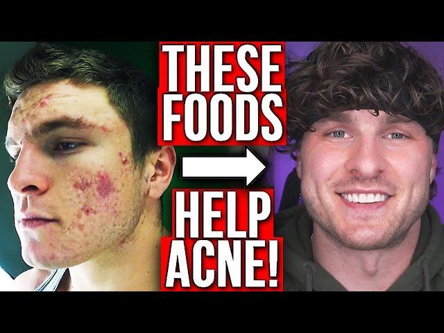 BEST FOODS TO GET RID OF ACNE (FROM EXPERIENCE)
