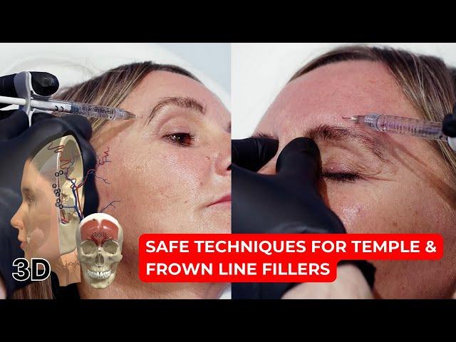 Mastering Temple and Frown Line Fillers: Safe Techniques for Resistant Cases