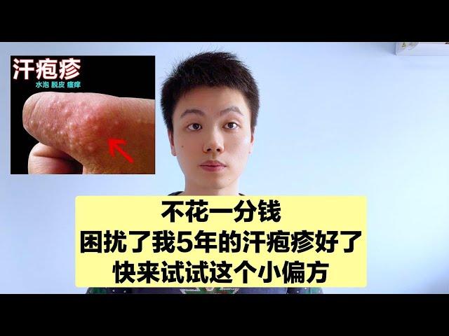 手上瘙痒的小水疱，反复发作怎么办？医生不花一分钱治好了汗疱疹【普外科曾医生】