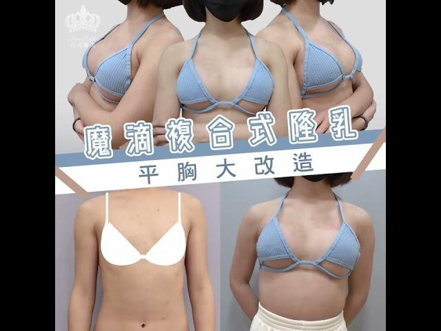 魔滴複合式隆乳 ▏平胸大改造，打造自然美胸！#尚凌診所