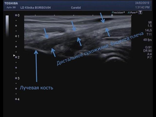 Передний косой скан для визуализации дистального сухожилия бицепса плеча
