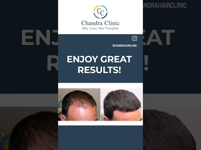 Growth Factor Concentrate Therapy Result | GFC Therapy in Delhi|Best Hair Transplant Clinic in Delhi