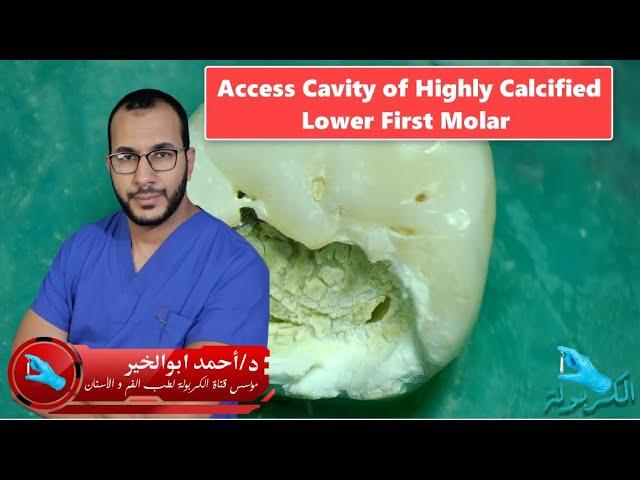 Access Cavity Demo on Highly Calcified Lower First Molar (ep 12)