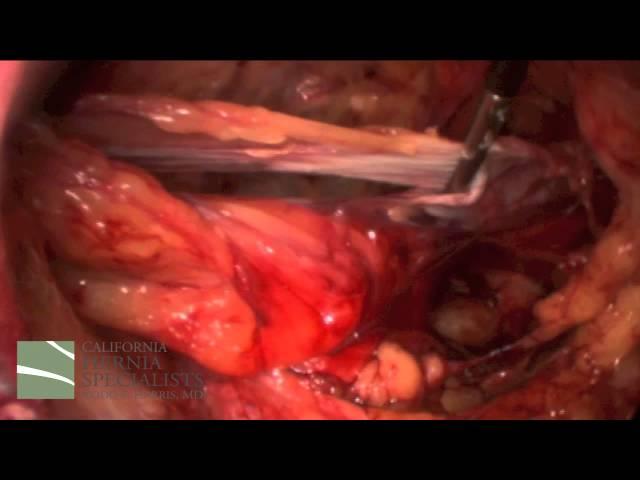 Laparoscopic Inguinal Hernia with Bladder, Edited Version by Dr. Todd S. Harris