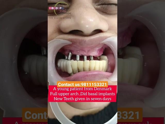 Basal implants in 7 days-New Teeth to a Denmark Patient-ऊपर के पूरे नए दांत केवल 7 दिनों में #shorts