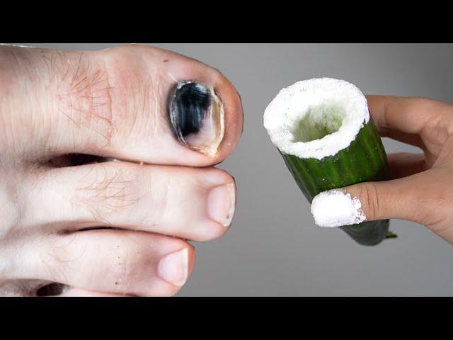 Cure Toenail Fungus For Less Than $1 / Have Toenail Fungus? You must do it!