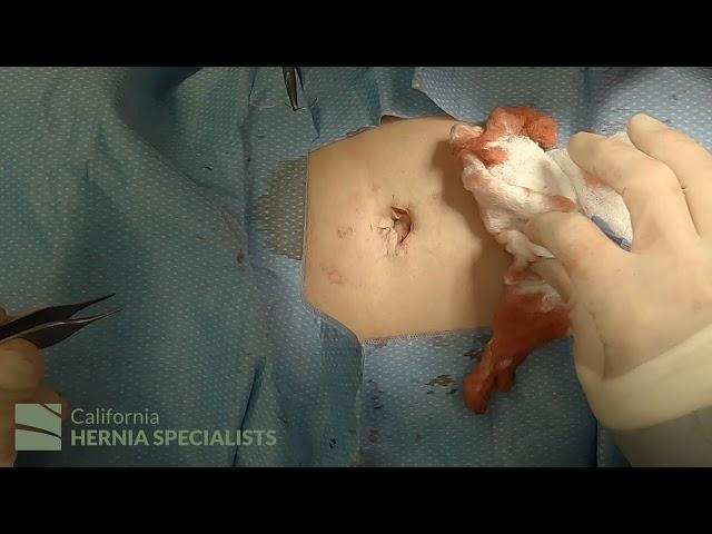 Open Umbilical Hernia Repair at California Hernia Specialists (4K)