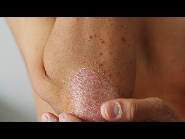 What Is Plaque Psoriasis?