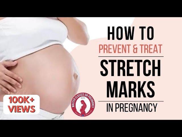 How to prevent and treat Stretch Marks in pregnancy| Dr Anjali Kumar | Maitri