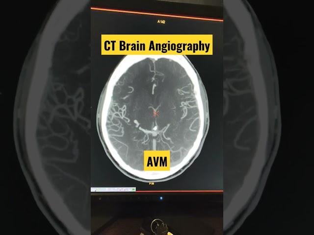 CT Brain Angiography Diagnosing AVM #shorts #trending #viral #radiology