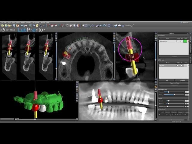 Routine Implant Planning in Blue Sky Plan v 4.5.9