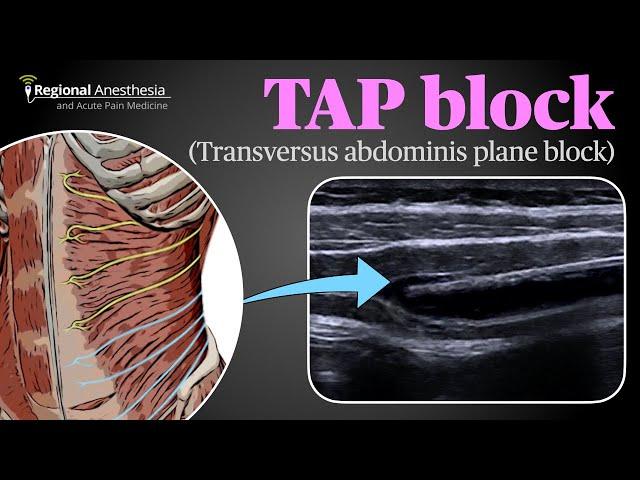 Ultrasound Guided Transversus Abdominis Plane (TAP) Block