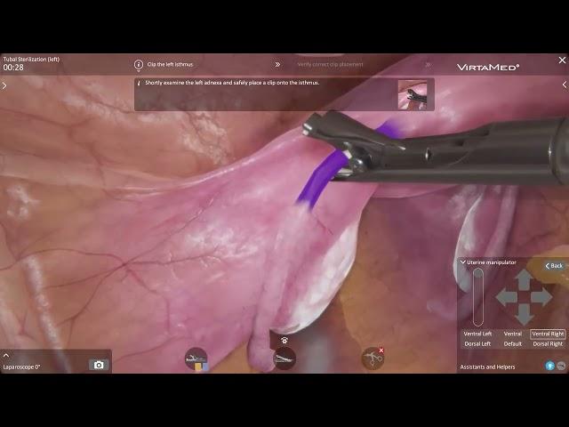 VirtaMed LaparoS™ - Tubal Sterilization Left