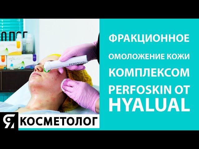 Фракционное омоложение кожи комплексом PerfoSkin от Hyalual