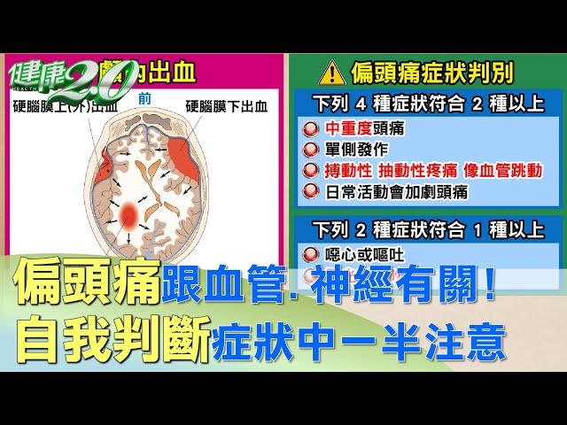 偏頭痛跟血管.神經有關！自我判斷症狀中一半注意 健康2.0